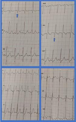 Left main coronary artery atresia in a 2-year-old toddler with de novo heart failure: Case report and review of the literature